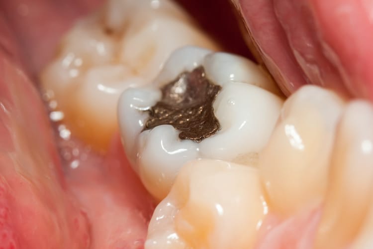 Amalgam Removal