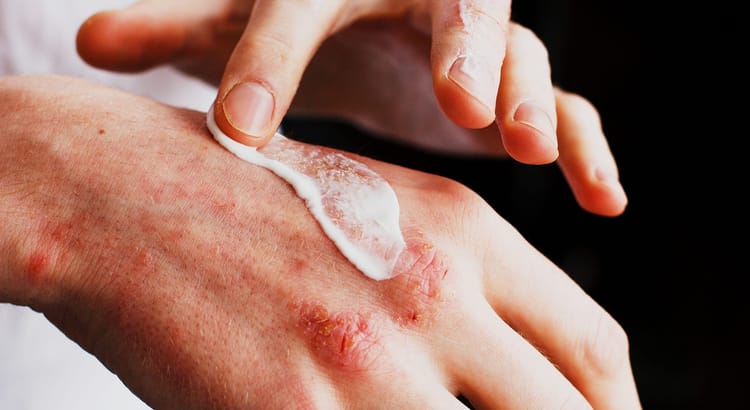 Eczema (Atopic Dermatitis)