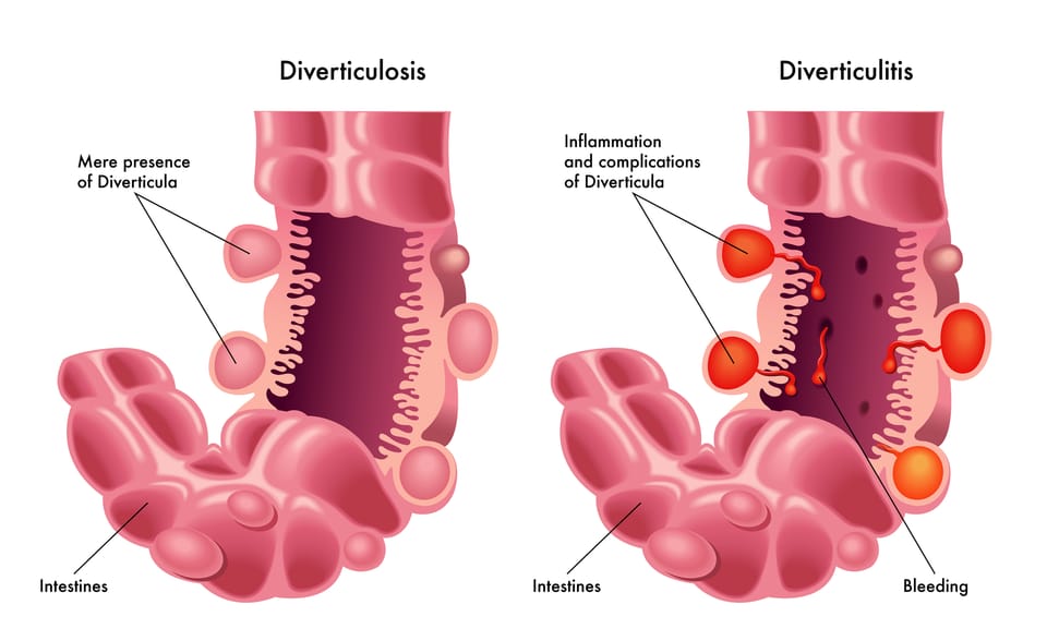 Diverticular Disease