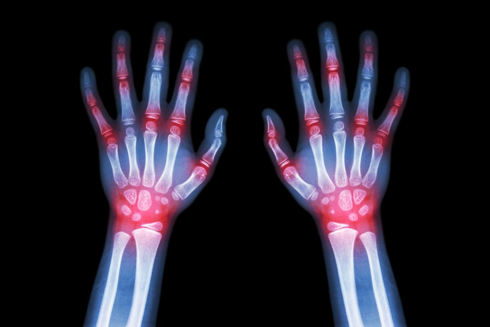 Arthritis (Rheumatoid)