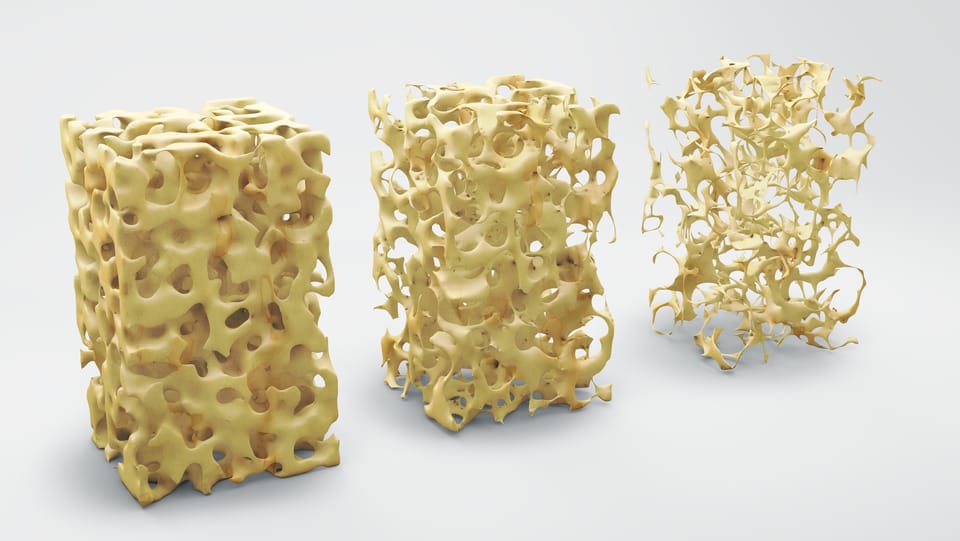 Bone Health (Osteoporosis)